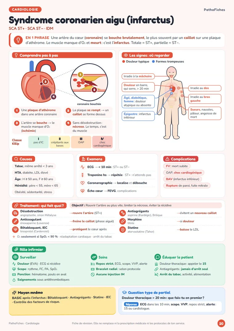 Fiche Syndrome coronarien aigu de PathoFiches